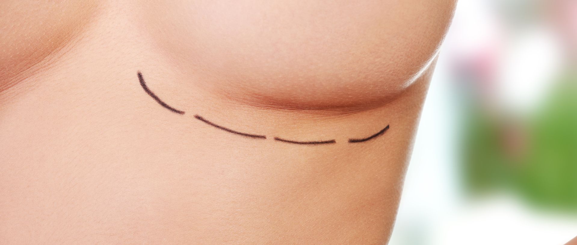 woman breast marked, breast augmantation