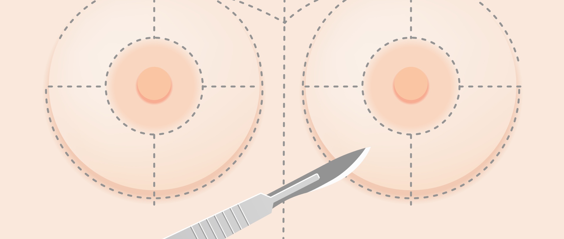 silicone breast implant surgery