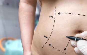 plastic surgery concept, hand is drawing lines on belly