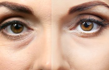woman face before and after plastic surgery procedure