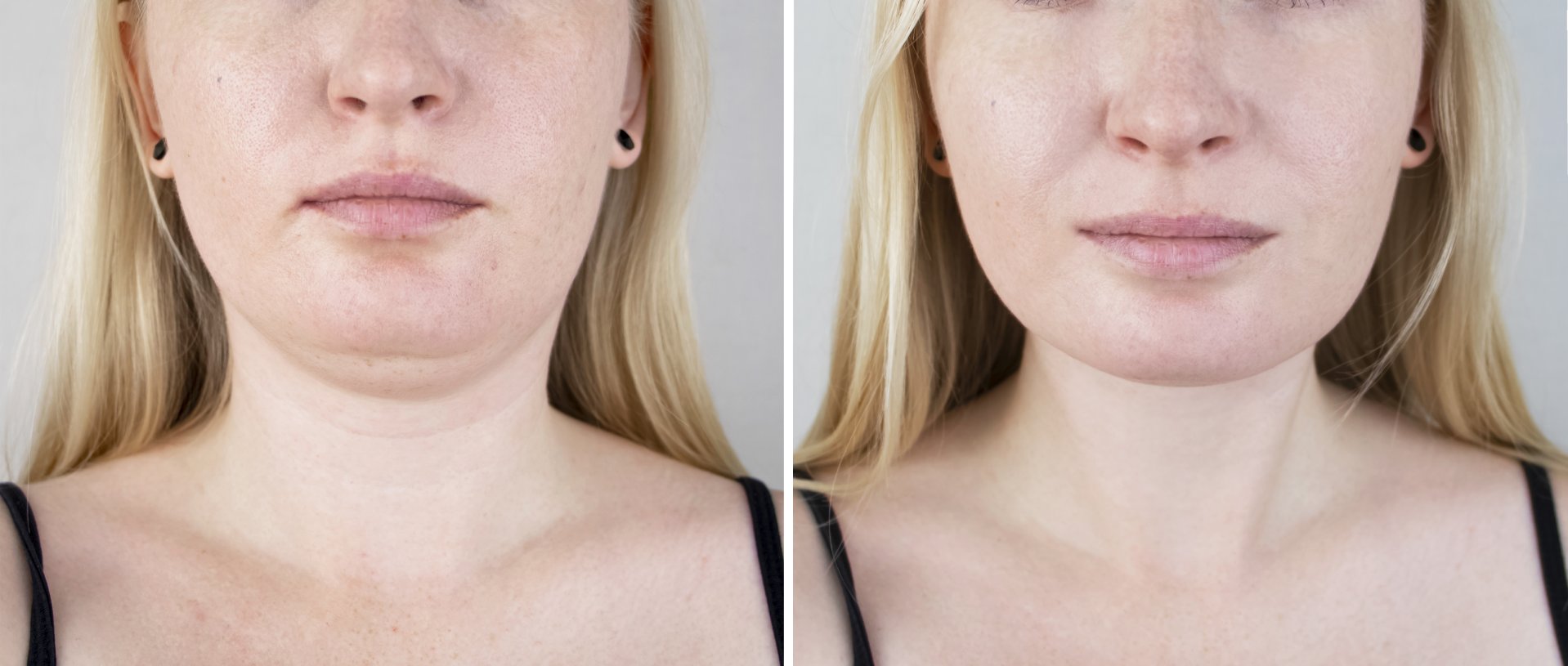 photos before and after chin fat removal and face contour correction