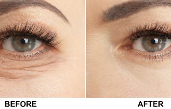mature woman before and after blepharoplasty procedure