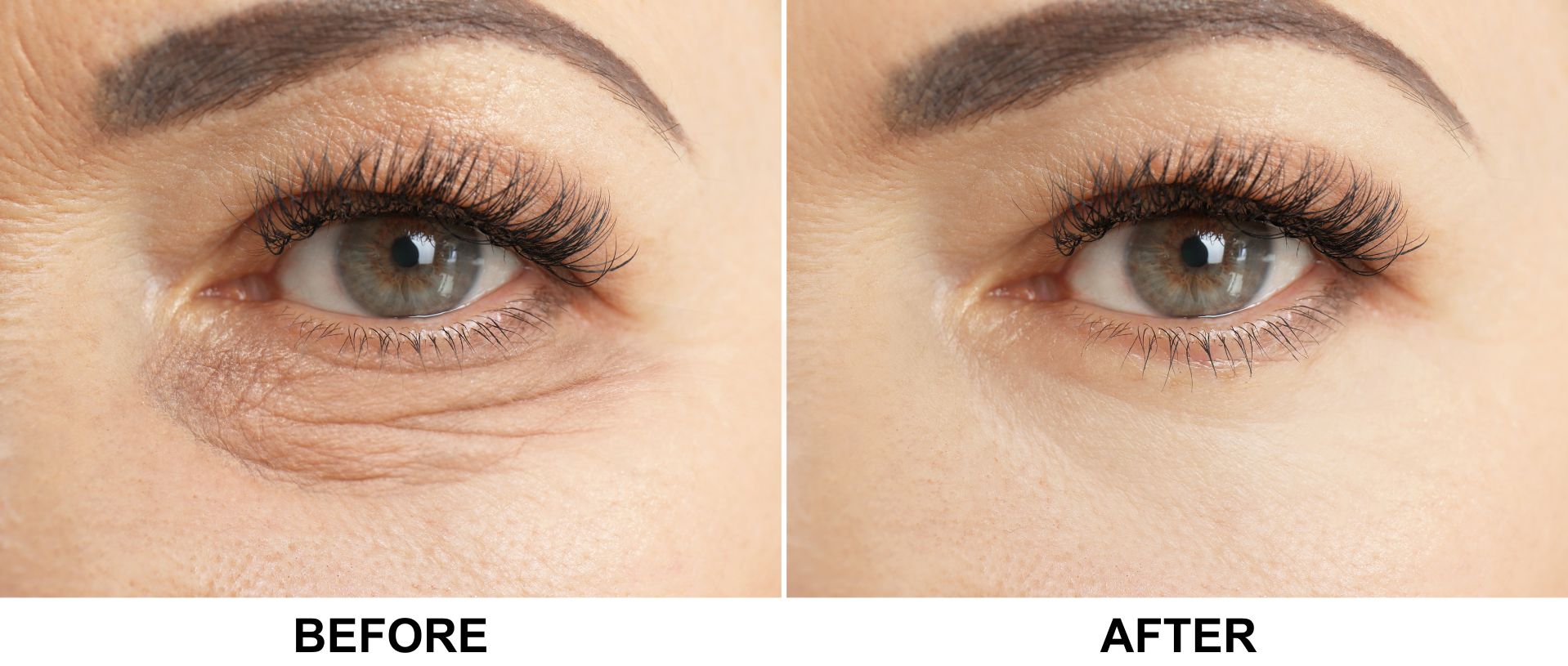 mature woman before and after blepharoplasty procedure