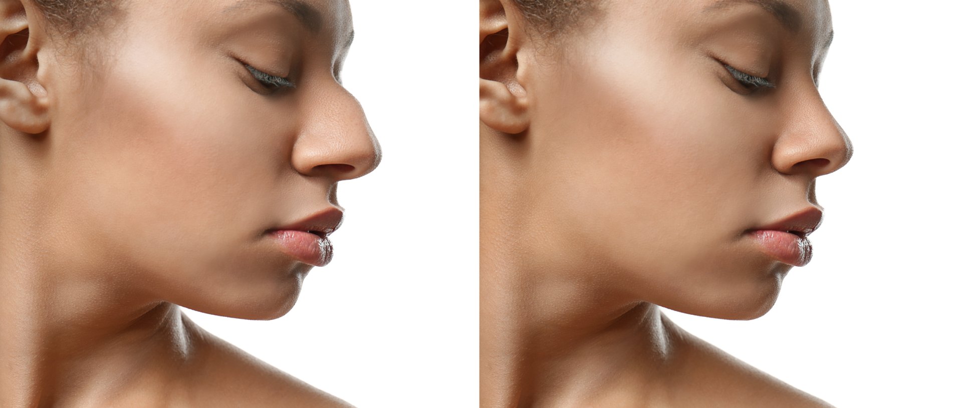 young African-American woman before and after rhinoplasty