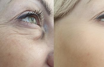 woman face wrinkles before and after treatment