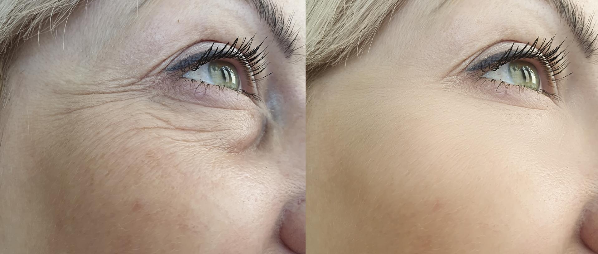 woman face wrinkles before and after treatment