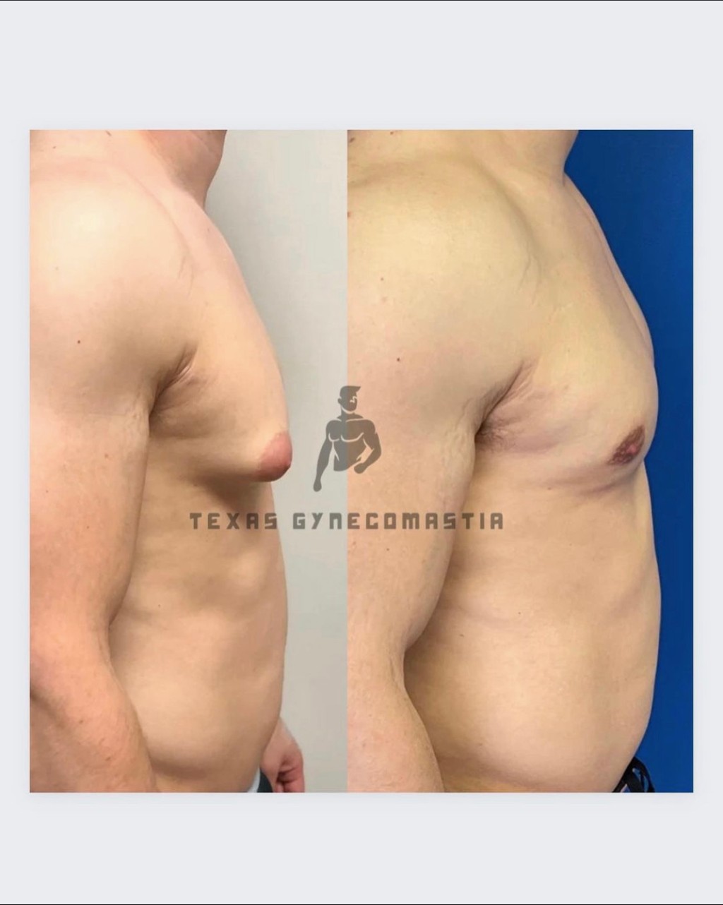 Gyno removal surgery by Dr. Azouz in Dallas, TX