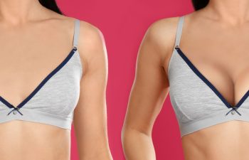 photos of young woman before and after breast augmentation