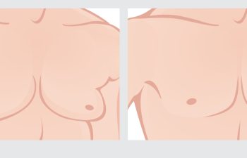 male chest reduction