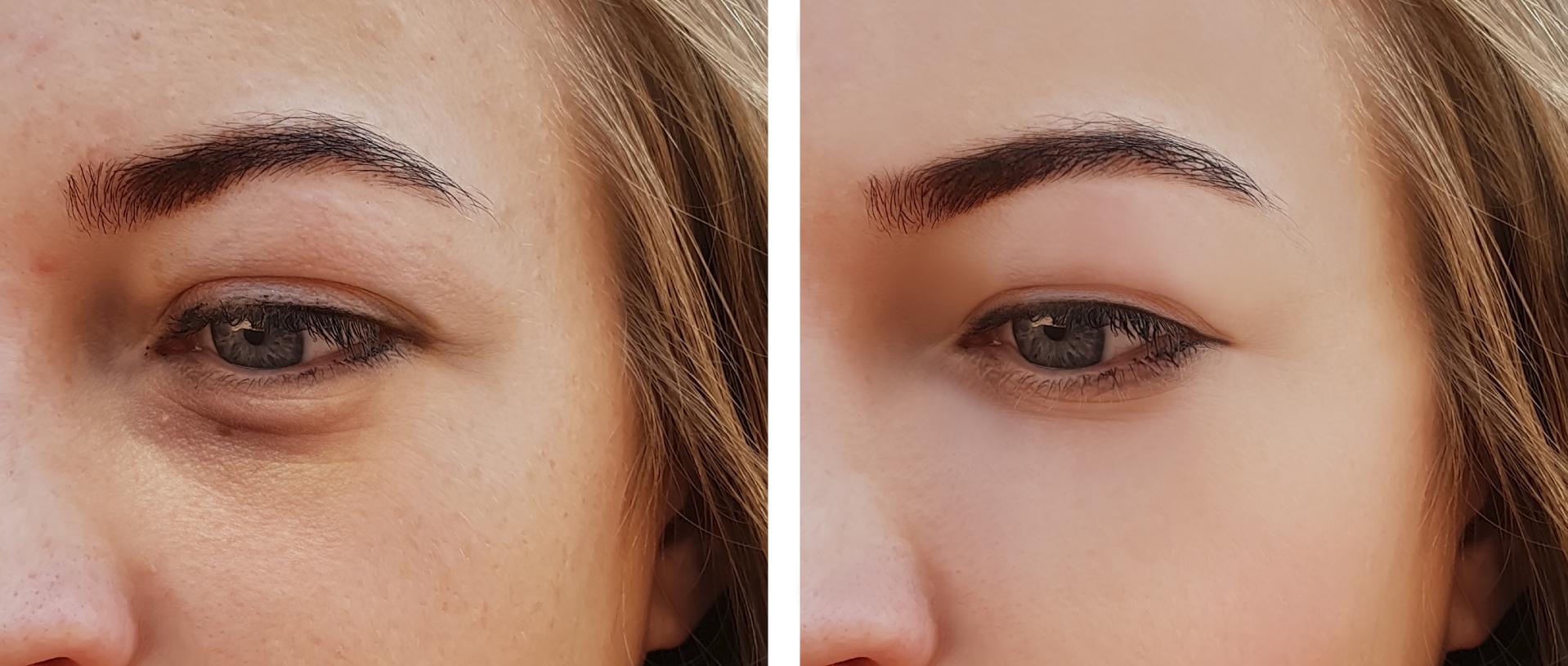 under the eyes before and after cosmetic procedures