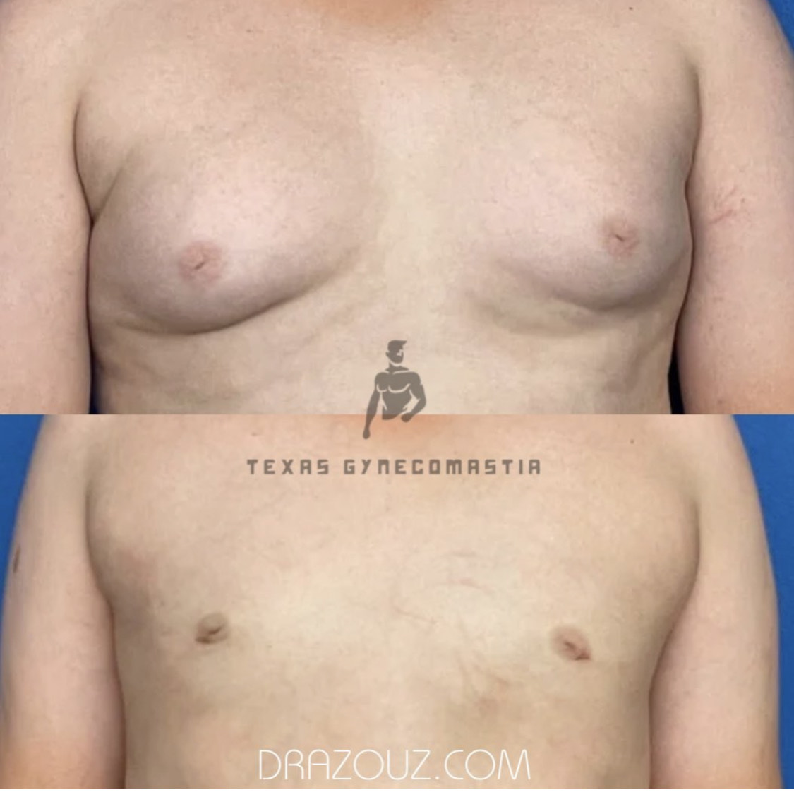 Cirugía de ginecomastia por el Dr. Azouz en Dallas, TX
