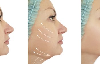 woman chin lift before and after procedures