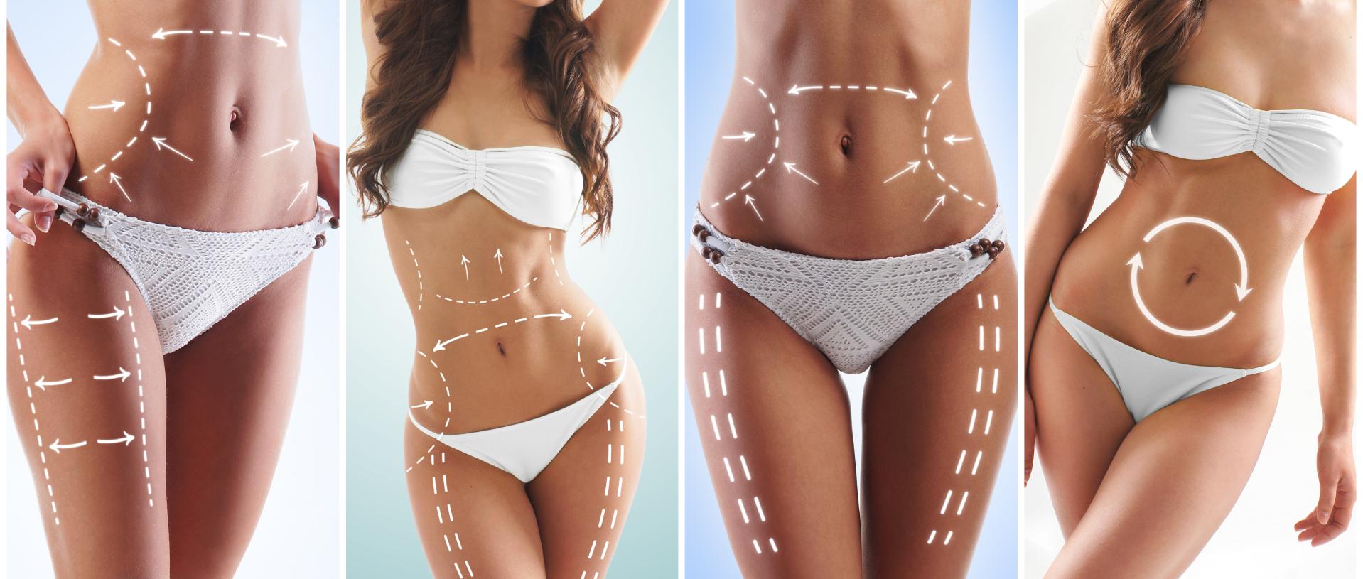 female body with the drawing arrows, liposuction and cellulite removal