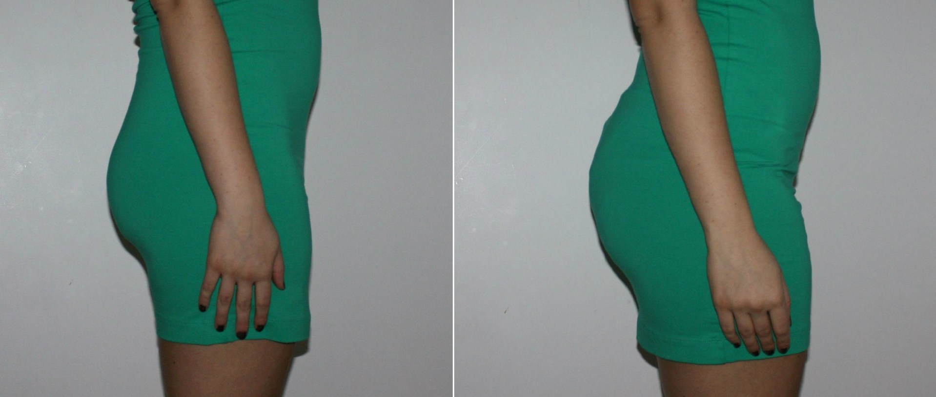 before and after photos of female butt lift