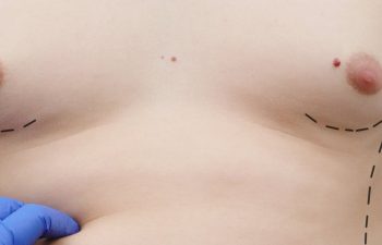 a plastic surgeon prepares a man for plastic surgery, gynecomastia surgeon