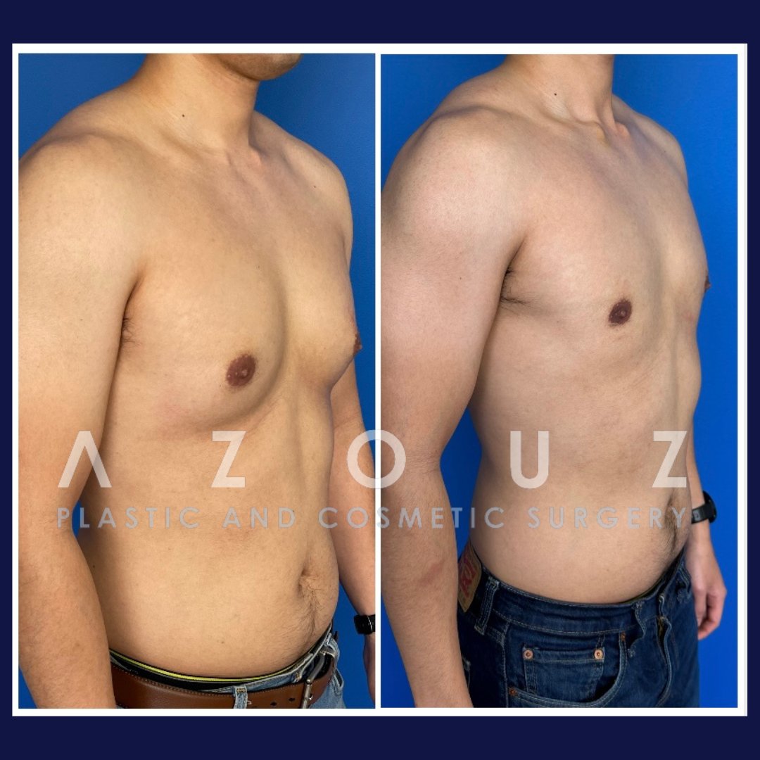 male breast removal in Dallas, TX by Dr. Solomon Azouz