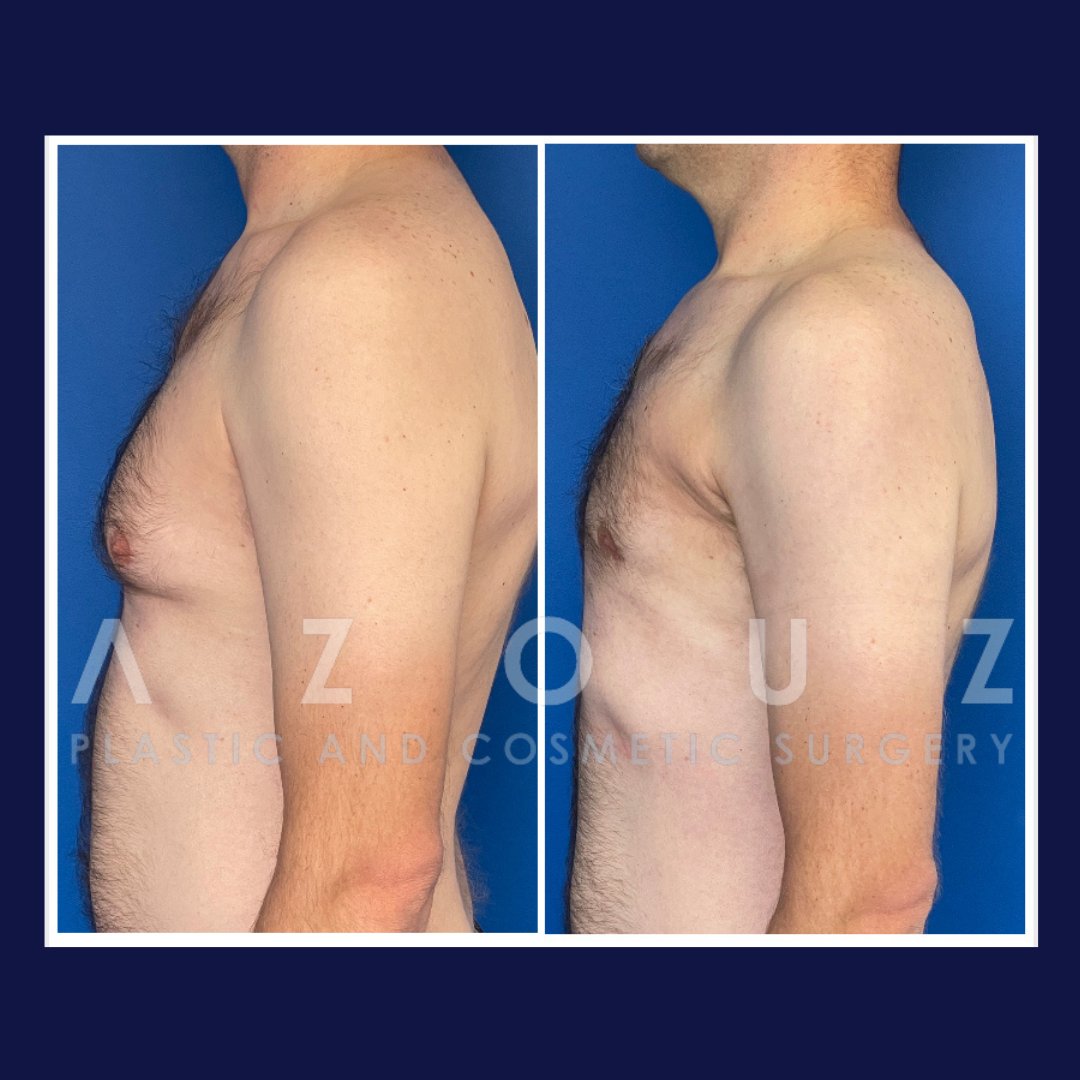 before and after gyno removal in Dallas, TX by Dr. Solomon Azouz