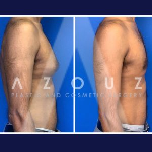 antes y después de la cirugía de ginecomastia en Dallas, TX por el Dr. Solomon Azouz