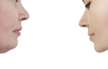 woman double chin before and after procedures removal