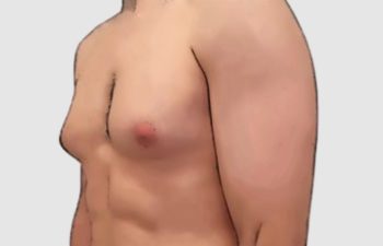 grades of gynecomastia