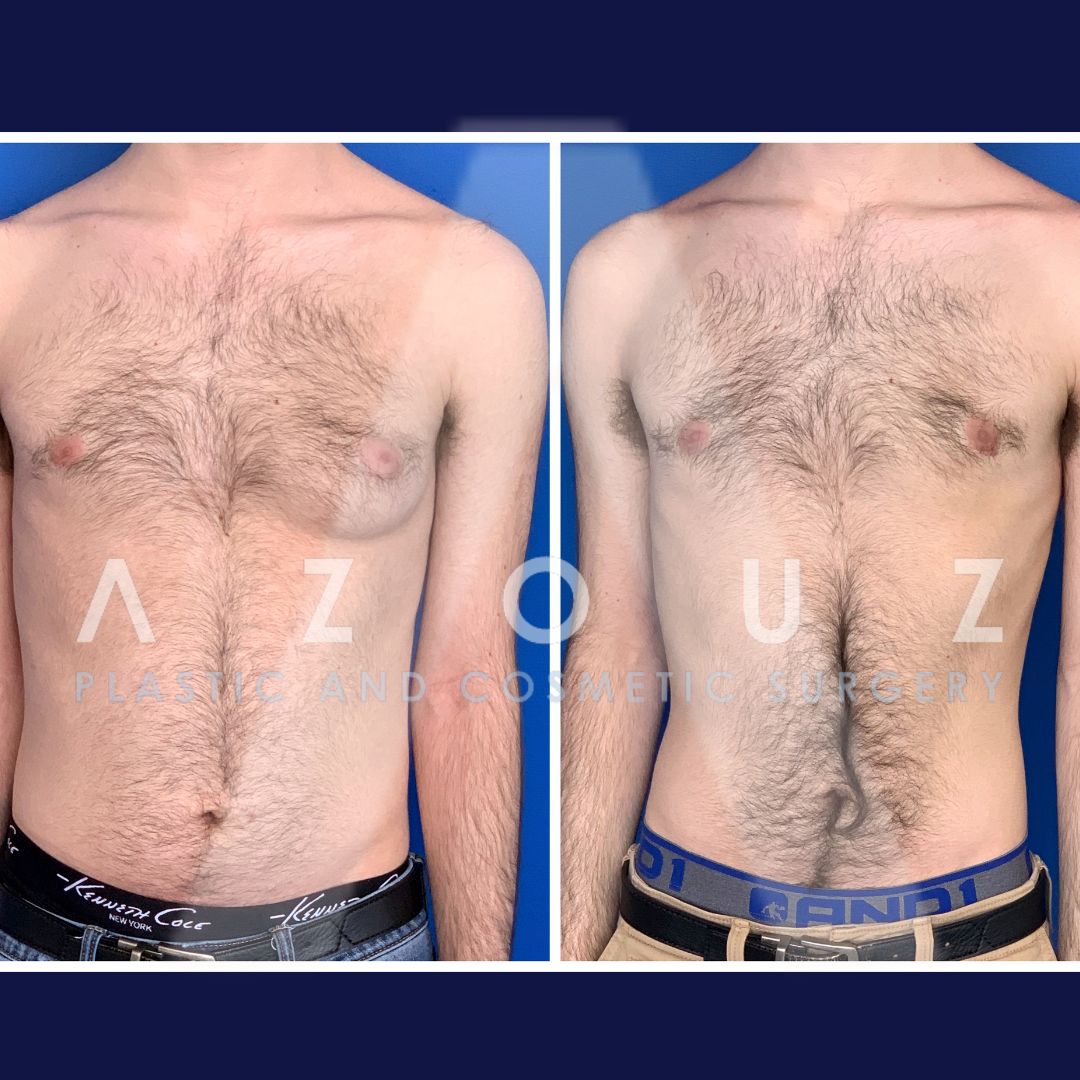 before and after man boob removal surgery in Dallas, TX by Dr. Solomon Azouz