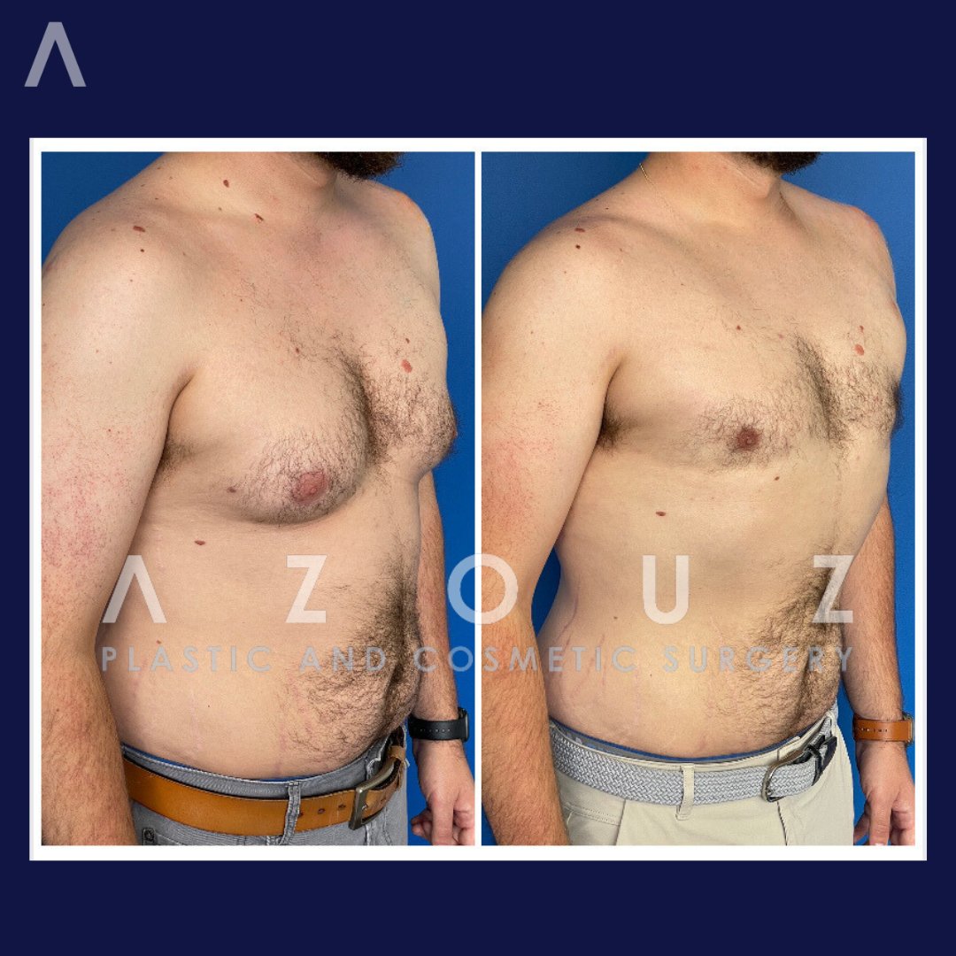 antes y después de la cirugía de extirpación de senos masculina en Dallas, TX por el Dr. Solomon Azouz”
