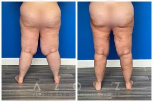 Lipedema patient before and after liposuction