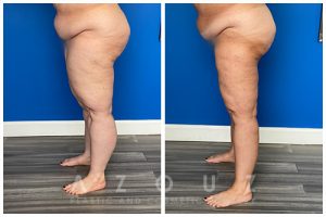 Lipedema patient before and after liposuction