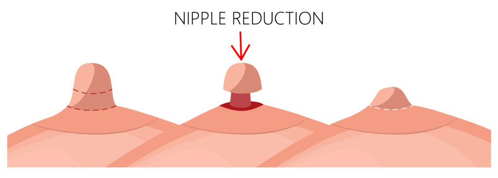 Nipple Reduction