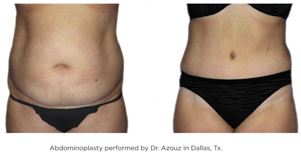 Abdominoplasty performed by Dr. Azouz in Dallas, TX