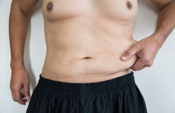 Tummy Tuck patient with loos skin on his abdomen.