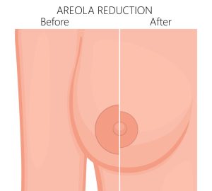 Areola Reduction 