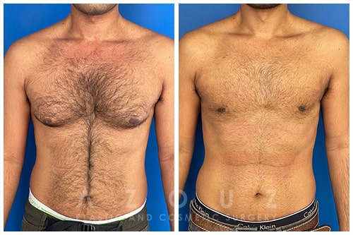 Before and After - Gynecomastia