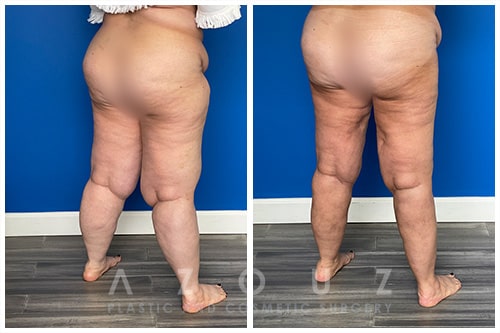 Before and After - Lipedema