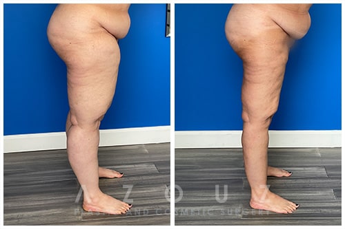 Before and After - Lipedema