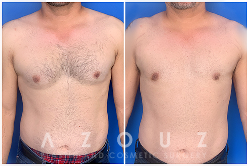 Gynecomastia patient before and after treatment