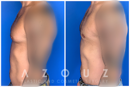 Gynecomastia patient before and after treatment
