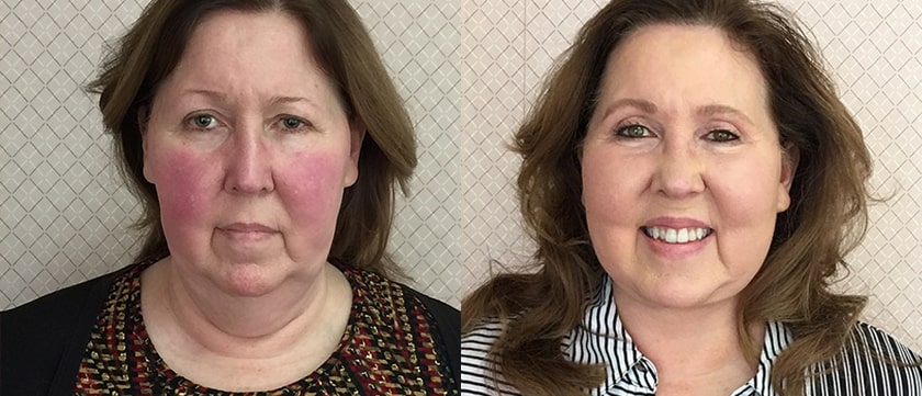 Before and After - Facelift