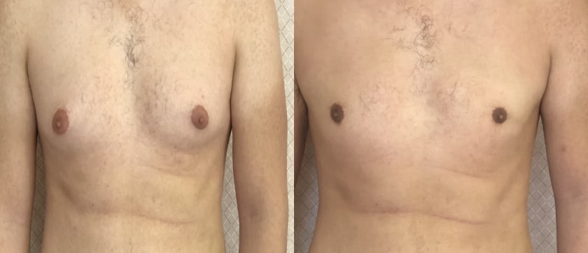 Before and After - Plastic surgery for men
