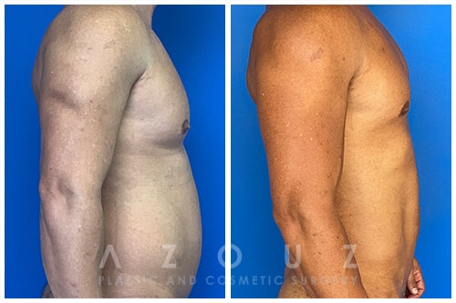Before and After - Liposuction