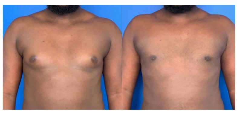 Before and After - Plastic surgery for men