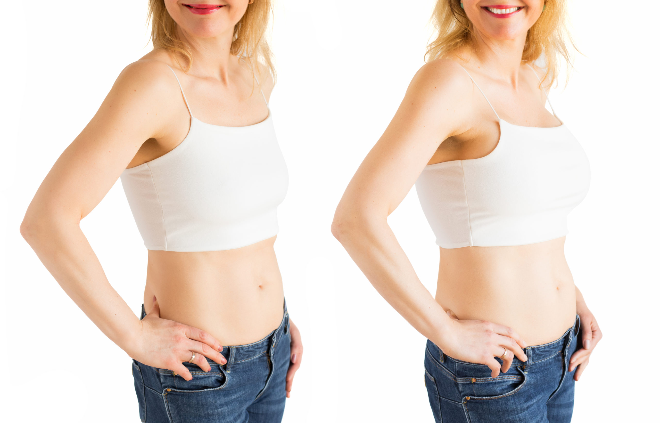 mujer antes y después del aumento de senos con transferencia de grasa