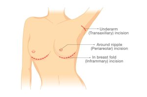 Breast Augmentation Incisions with Dr. Azouz | Dallas & Plano. Description: Underarm (Transaxillary) inision. Around nipple (Perlareolar) incision. In breast fold (Inframmary) incision