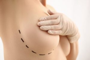 Woman's breast with presurgical marking
