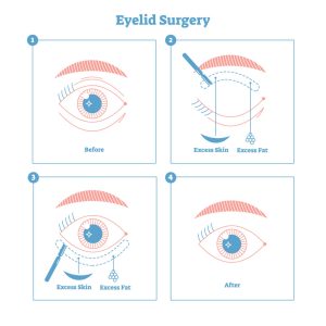 Eyelid surgery 4 steps: 1 - Before, 2 - Escess Skin - Excess Pot, 3 - Excess skin removal, 4 - After