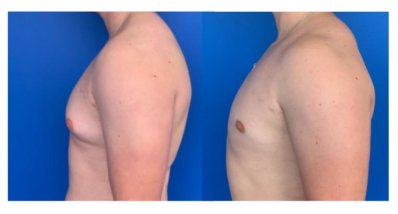 Before and After Gynecomastia Surgery Dr. Azouz Dallas