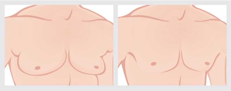 Gynecomastia Before and After Surgery