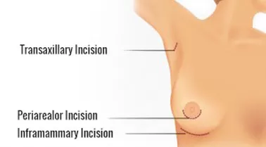 picture of camouflaged breast recounstruction incision. Transaxillary Incision pointing to armpit, Periarealor Incision pointing to nipple and Inframammary Incision pointing to breast