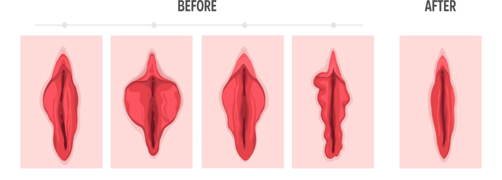 Labiaplasty Surgery Precudere Before and After Graphics