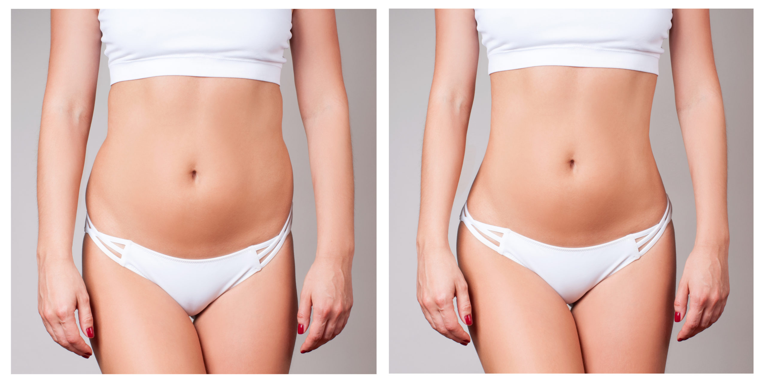 woman body before and after liposuction